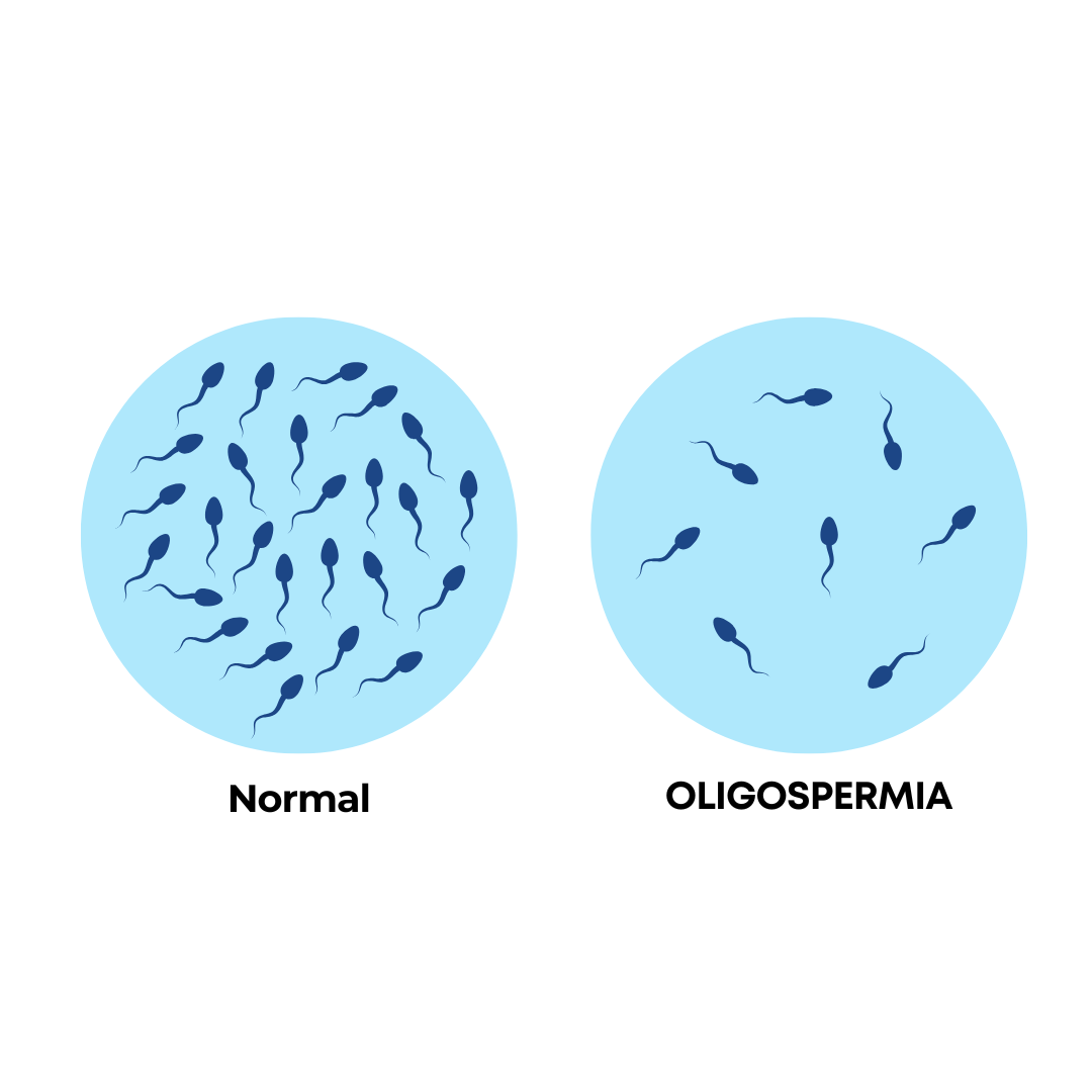 Jumlah-Sperma-Sedikit-Waspadai-Oligospermia-dan-Dampaknya-pada-Kesuburan.png
